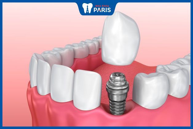 Implant là phương pháp trồng răng số 3 tốt nhất