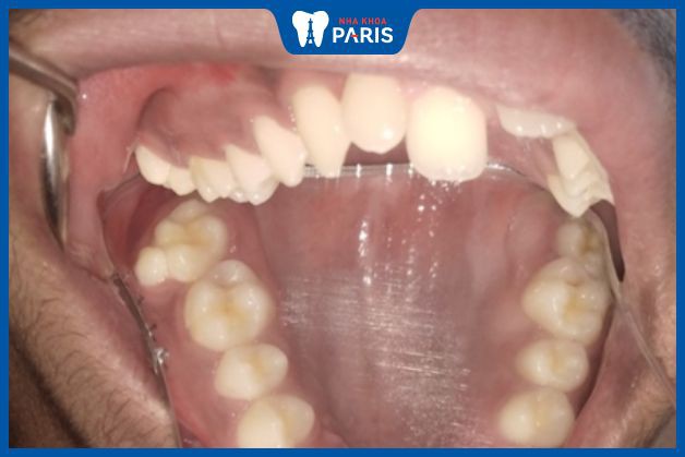 Mọc thừa răng số 9 dễ gây ra bệnh lý và khó chịu