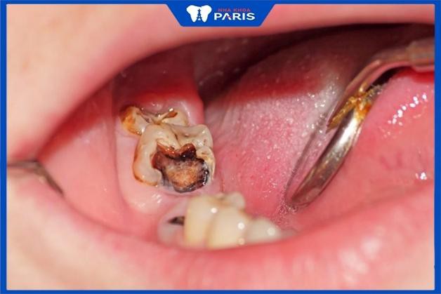 Triệu chứng bị xiết ăn răng như thế nào?