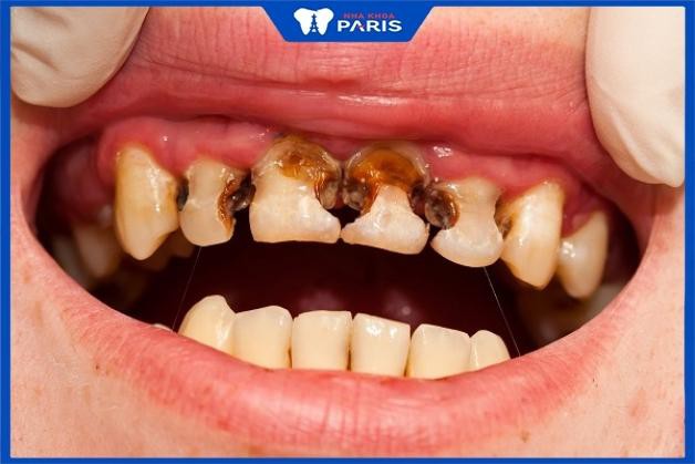 Xiết ăn răng là gì? Nguyên nhân do đâu?