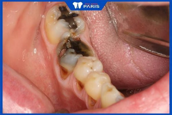 Xiết ăn răng là gì? Cách điều trị xiết ăn răng ở người lớn và trẻ em an toàn