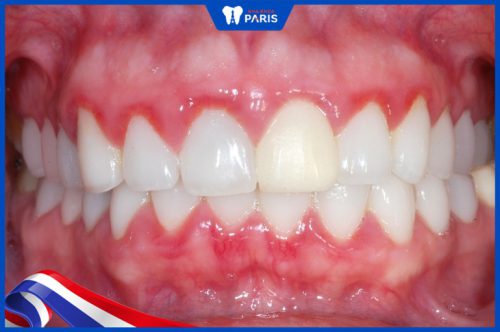 Dán răng sứ có hại không?