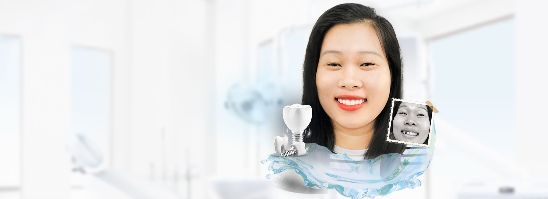 trồng răng sứ