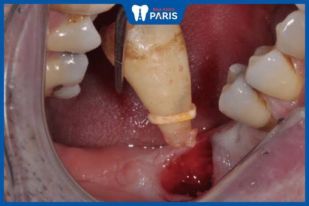 Lỗ nhổ răng khôn không nguy hiểm nhưng phải chăm sóc cẩn thận