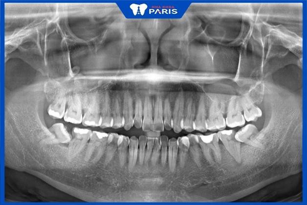 Kết quả chụp phim X-quang răng