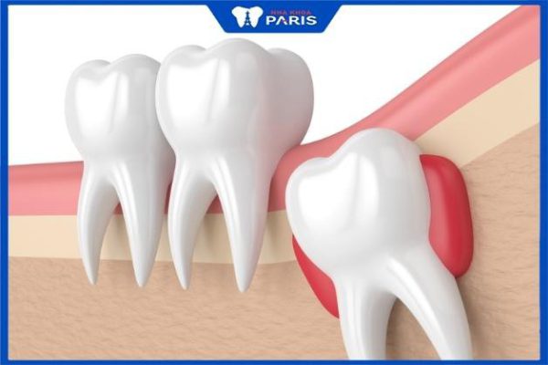 Nhổ răng khôn có được hưởng bảo hiểm y tế không?Bác sĩ nha khoa giải đáp