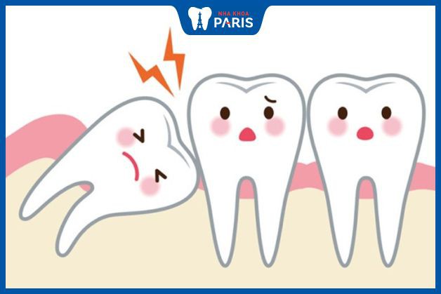 Nhổ răng khôn có phải khâu không phụ thuộc vào tình trạng răng