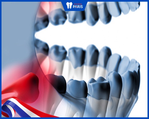 Nhổ răng khôn hàm trên hay hàm dưới nguy hiểm hơn?