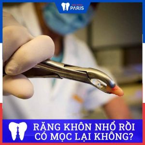 Nhổ răng khôn có mọc lại không – Bác sĩ nha khoa giải đáp