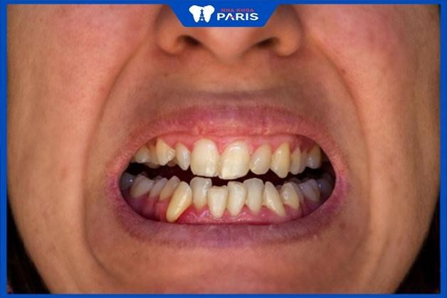 Răng bị quặp là gì? 