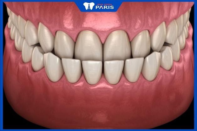 Răng bị quặp vào trong có gây ảnh hưởng hay nguy hiểm gì không?