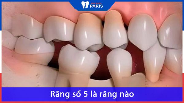 Răng số 5 là răng nào? những ảnh hưởng của việc mất răng số 5