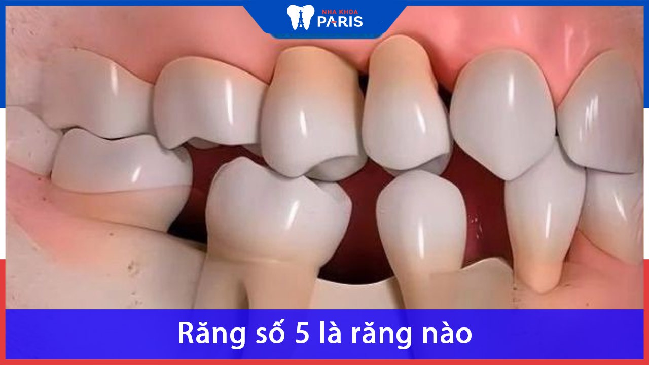 Răng số 5 là gì? Hậu quả khi mất răng số 5 và giải pháp
