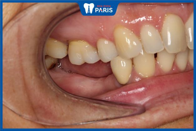 Mất răng số 7 ảnh hưởng nặng tới sức khỏe và sinh hoạt