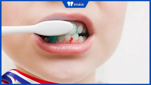 nguyên nhân chảy máu chân răng ở trẻ