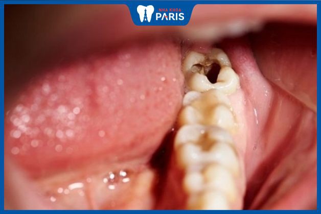 Lỗ sâu răng tạo điều kiện cho cặn thức ăn giắt lại