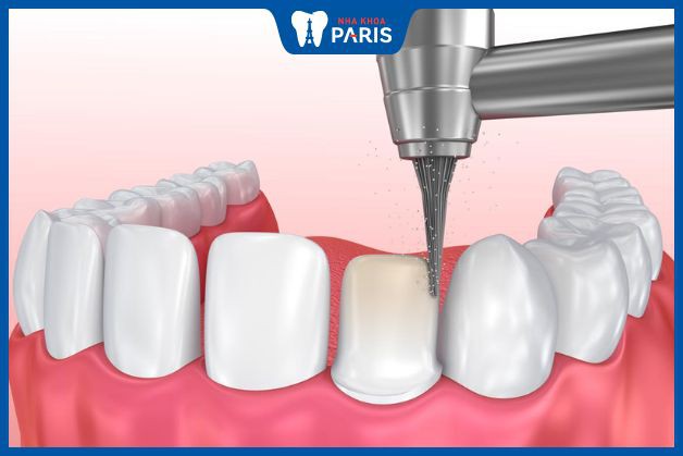 Bác sĩ mài răng sai kỹ thuật có thể khiến cho răng sứ nhanh hỏng