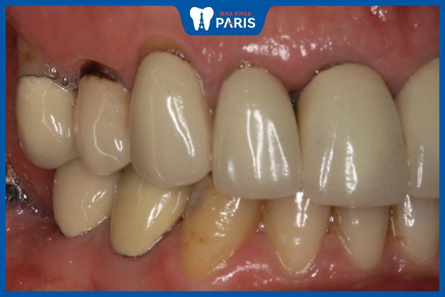 Răng sứ kim loại bị đen sau một thời gian dài sử dụng