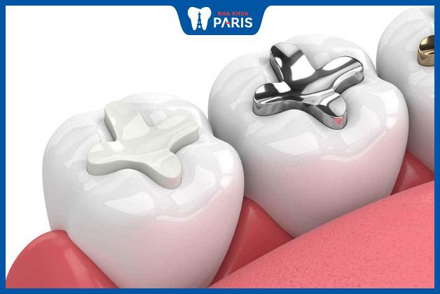 Composite là vật liệu trám răng phổ biến nhát