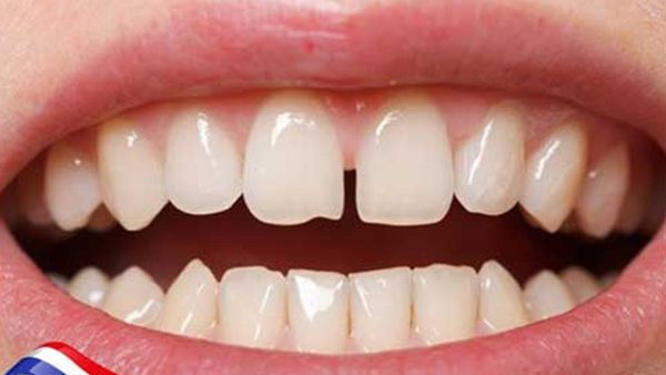 Trám răng cửa trong trường hợp nào? Lưu ý khi phục hình răng