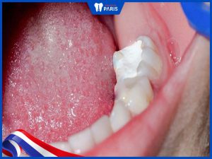 Tự trám răng tại nhà có được không? Liệu có tác hại gì không?