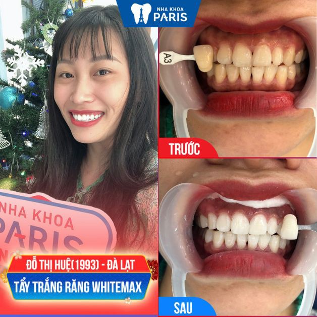Nha khoa Paris tẩy trắng răng hiệu quả