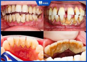 Có nên lấy cao răng thường xuyên không? Định kỳ 3-6 tháng/lần
