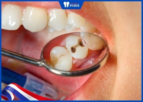 lấy vôi răng ngăn chặn bệnh lý răng miệng