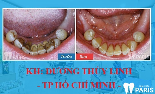 Kết quả trước và sau khi lấy cao răng