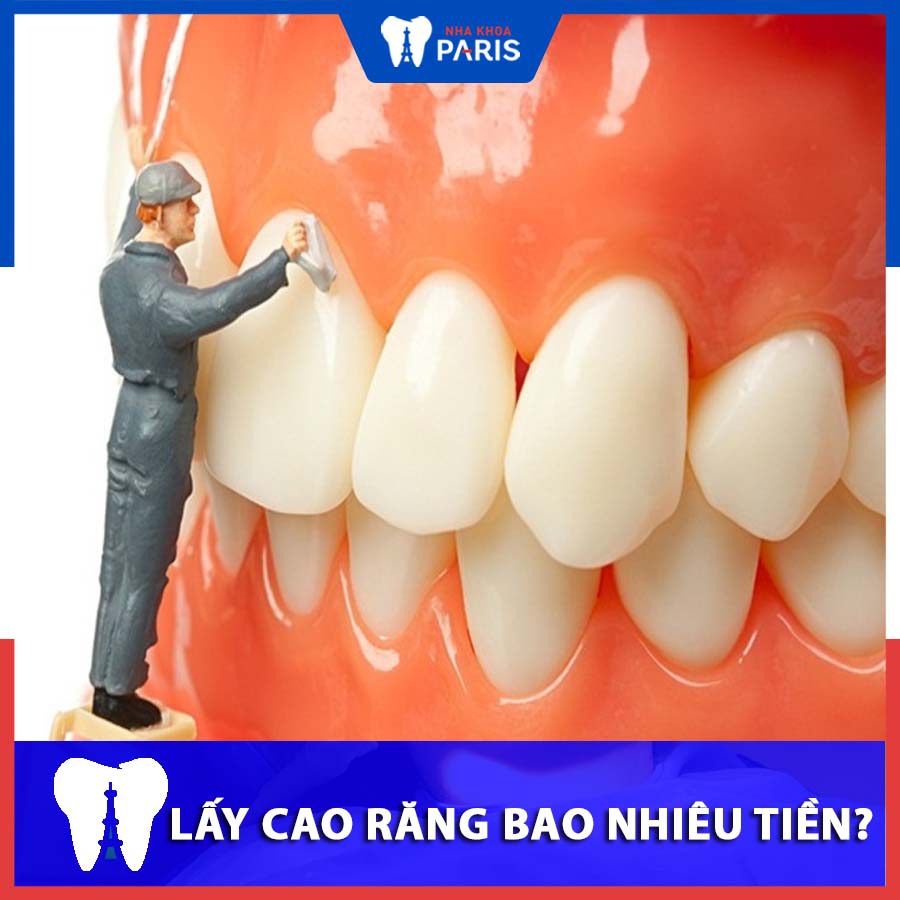 Lấy cao răng giá bao nhiêu tiền? Bảng giá Mới 2024