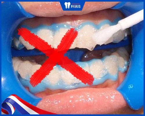 Không tẩy trắng răng ngay sau khi cạo vôi