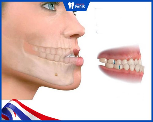 Hàm móm ảnh hưởng đến chức năng nhai của răng