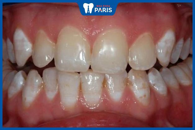 Răng không đều màu sau khi sử dụng thuốc tẩy trắng răng sai cách