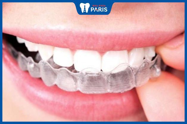 Dùng thuốc tẩy trắng răng tại nhà dễ bị dính vào lợi