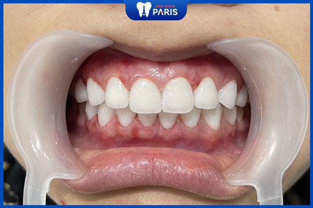 Răng Emax có tính thẩm mỹ cao