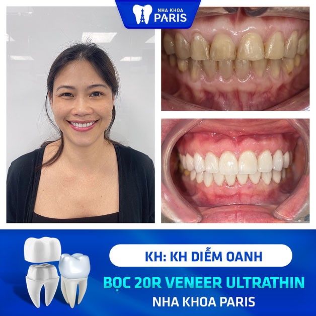Khách hàng Diễm Oanh dán 20 răng sứ Ultrathin