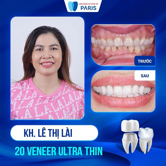 Khách hàng Lê Thị Lài dán 20 răng sứ Ultra thin