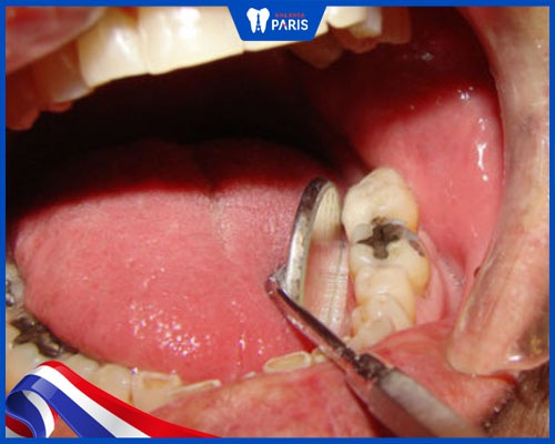 Bọc răng sứ gặp rủi ro khi không điều trị triệt để bệnh lý nền