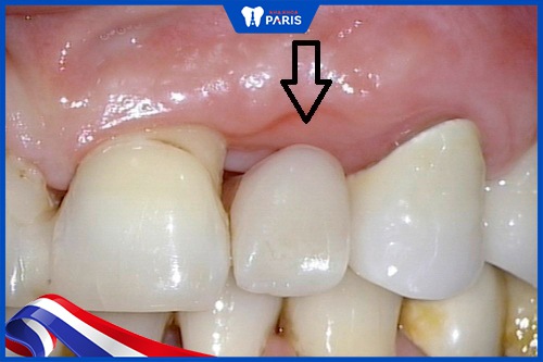 Thức ăn thường hay bị mắc lại ở chân răng.