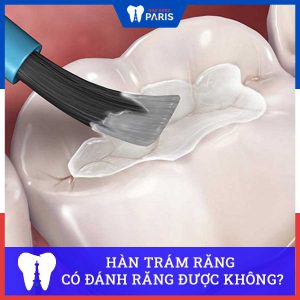 Trám răng xong có đánh răng được không – Bác sĩ nha khoa giải đáp