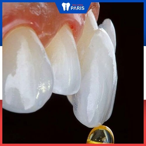 Keo lỏng lẻo làm răng sứ nhanh tụt