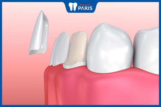 Veneer là phương pháp thẩm mỹ răng hiện đại