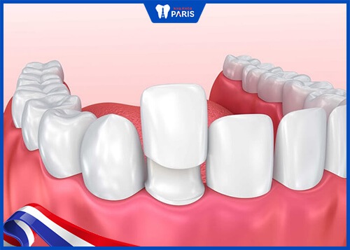 Bọc răng sứ khắc phục răng mẻ tối ưu nhất 