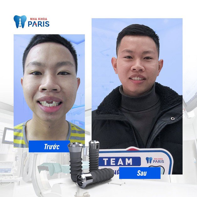 Trồng Implant răng mất tại nha khoa Paris