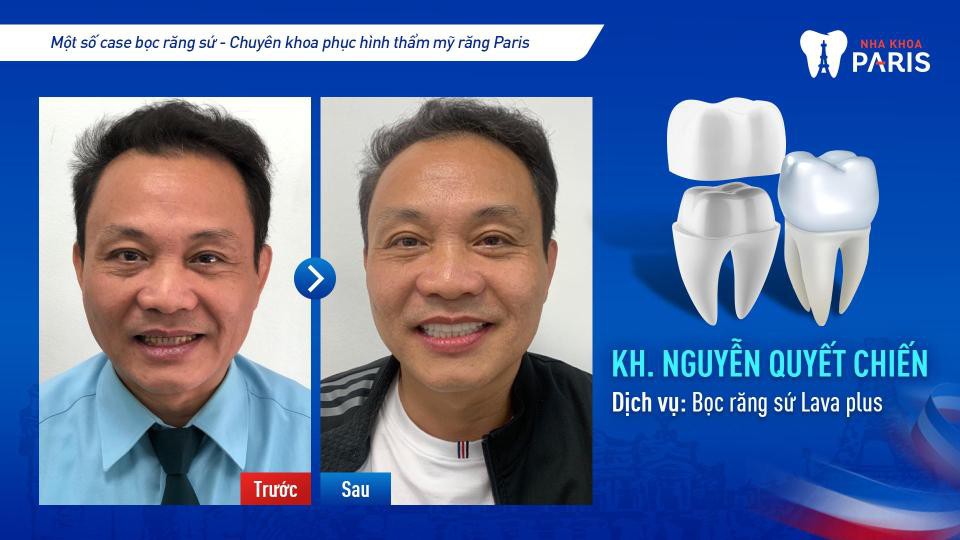 Bọc răng sứ tại Hà Nội