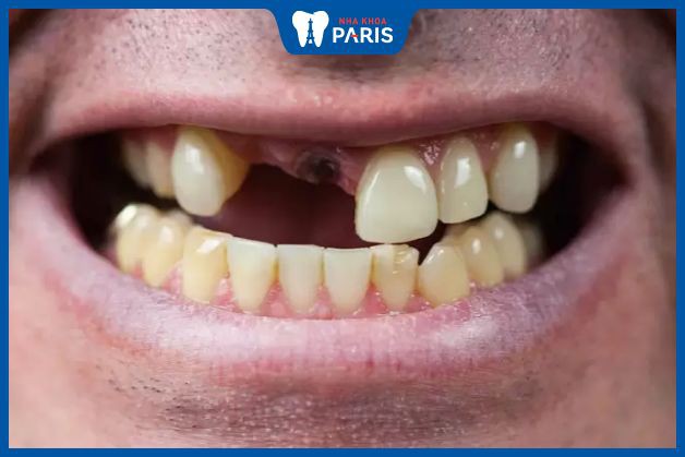 Mất răng cửa có những tác hại gì?