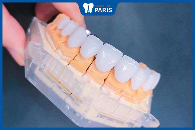 Nên chọn loại mão sứ nào khi cấy Implant răng cửa