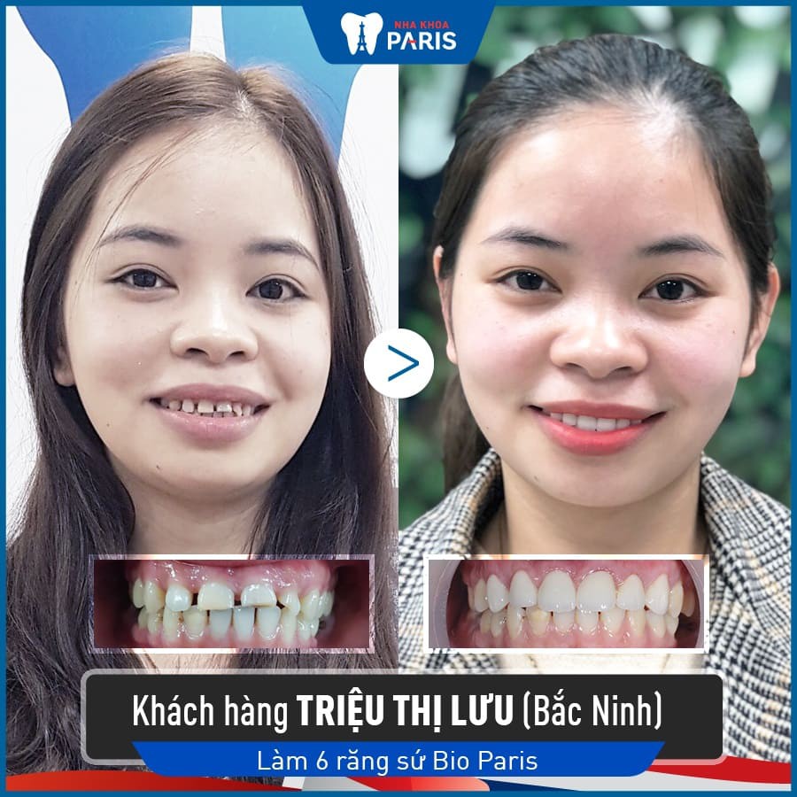 Bọc răng sứ tại Bắc Ninh