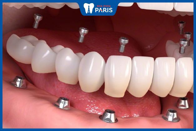 Trồng răng hàm cần chọn loại cứng, bền nhất