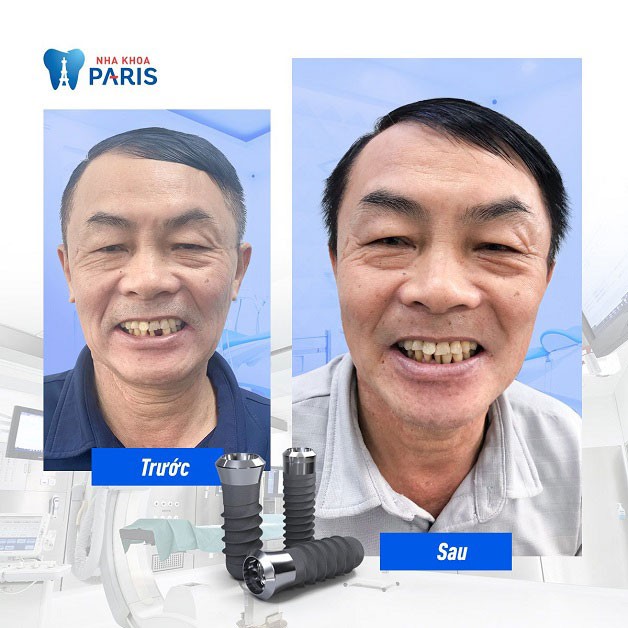 Implant tại Paris có thể sử dụng vĩnh viễn